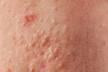 Fototapeta premium Young person with acne problem, closeup view of skin