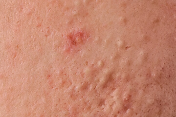Young person with acne problem, closeup view of skin