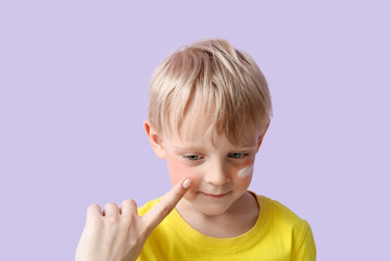 Woman applying cream onto her allergic little son's face on lilac background, closeup
