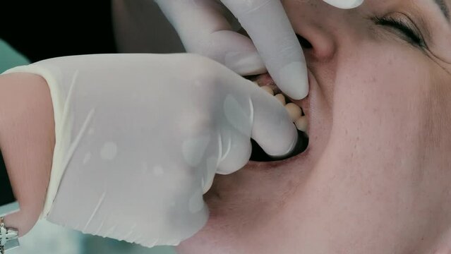 The process of installing veneers. Installation of veneers in modern dentistry. Close-up of a patient in a chair during a procedure Dental prosthetics. Dental care concept. Metal-ceramic crowns and