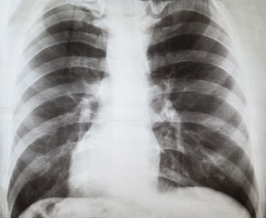 X-ray of human lungs
