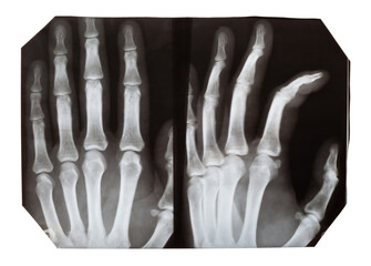 X-ray images of a hand in different projections, on a white