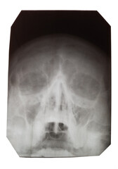 X-ray of a human skull on a white
