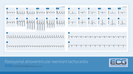 Male, 48 years old, paroxysmal palpitations for 10 years. ECG showed left posterior septum bypass tract and paroxysmal supraventricular tachycardia.