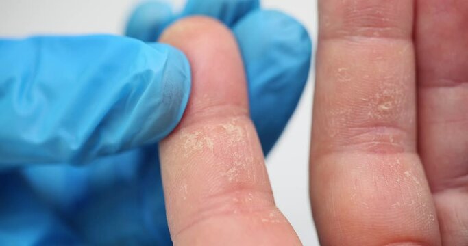 Peeling of palms and fingers of allergy. Fingers of a man with eczema and peeling due to dermatitis skin of palms peels off allergic reaction on body