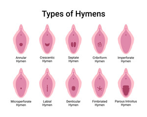 Types of Hymens Medical Vector Illustration