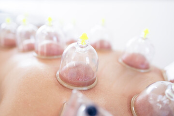 Traditional hijama treatment and therapy for healthy body.