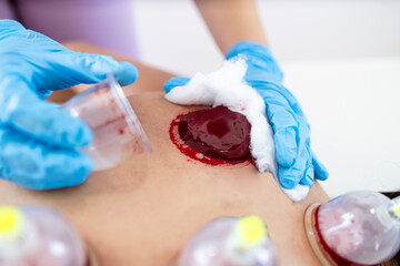 Hijama expert removing clotted capillary blood from the cup after the treatment.