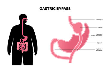 Gastric bypass surgery - obrazy, fototapety, plakaty