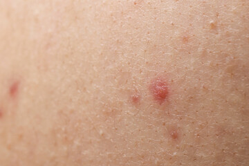 Fototapeta premium Young person with acne problem, closeup view of skin