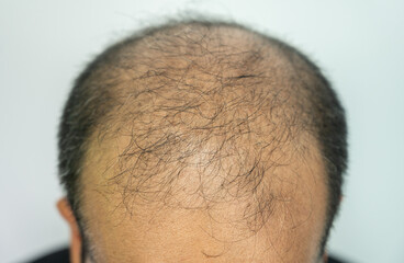 Close up of top view of baldness men's scalp. Baldness is related to your genes and male sex hormones.