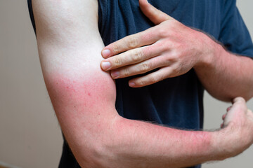 Young caucasian man with sunburn red skin arms