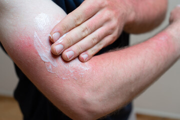 Young caucasian man with sunburn red skin arms applying sunscreen cream