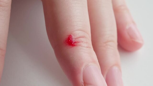  gel-like red blood clot at the site of a cut on a woman's middle finger, the final stage of coagulation preceding.