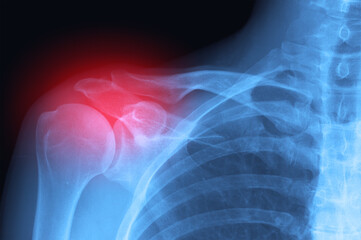 Real X-ray scan - joint inflammation or broken arm and shoulder trauma pain. Radiology diagnosis.