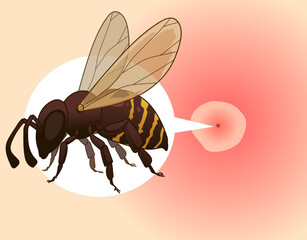 Bee sting. Injury after a bee sting.  Redness on the skin. Closeup illustration. Healthcare illustration, vector illustration. 