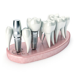 Dental implants, high quality, modern medicine, unusual background.