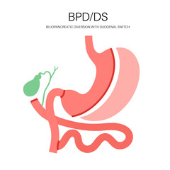 Biliopancreatic diversion procedure