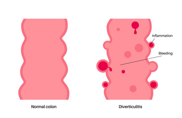 Diverticulitis and diverticulosis