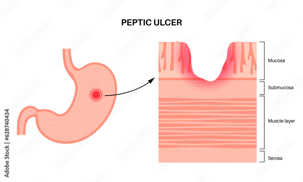 Sticker Peptic ulcer disease