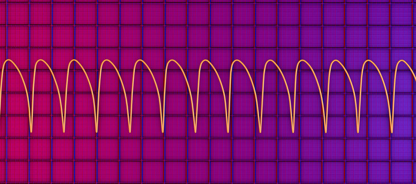 Electrocardiogram displaying ventricular tachycardia, 3D illustration
