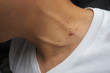 Many skin tags or Acrochordon on the neck of an Asian male. They are small soft and common benign on the human skin especially on adult skin and can be irritated by shaving and daily clothing - obrazy, fototapety, plakaty
