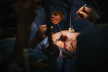 Fototapeta premium Team of medical professionals performing surgery on a patient.