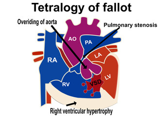 The picture show the structure of tetralogy of fallot that show the 4 part defect of heart which is overriding of aorta , pulmonary stenosis  ,VSD, right ventricular hypertrophy for medical concept