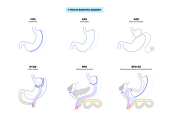 Obraz premium Bariatric surgery poster