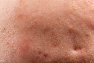 Young person with acne problem, closeup view of skin