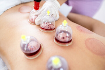 Close up view of vacuum cups filled with blood during hijama cupping therapy.