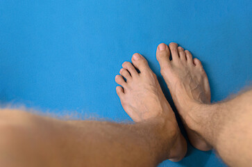 Pies de hombre con várices y venas varicosas, descalzo, sobre tela o paño azul