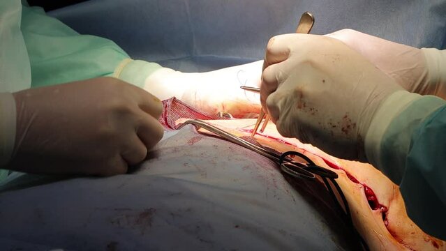 Skilled surgeon and assistant suturing during surgery. Precise and professional medical footage for presentations and educational use.