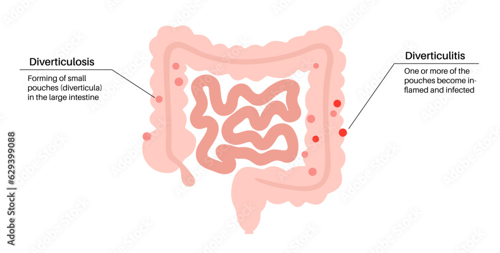 Wall mural Diverticulitis and diverticulosis