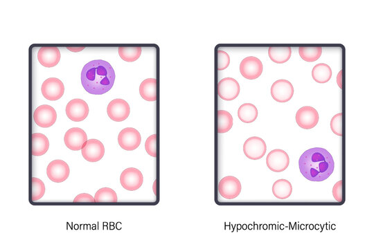 The difference of Normal red blood cell and Hypochromic-Microcytic in light microscope. Blood morphology vector.