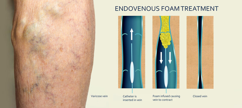 Endovenous laser treatment for varicose veins - foam sclerotherapy concept.
