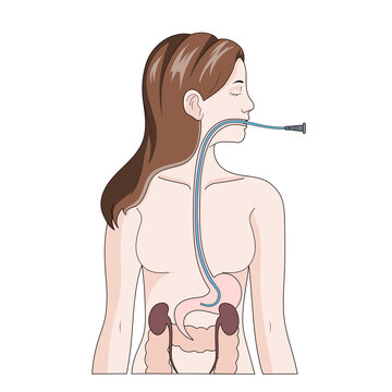 Nasogastric intubation diagram schematic raster illustration. Medical science educational illustration