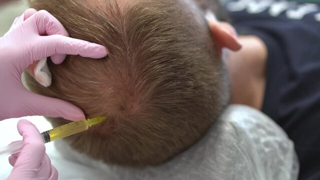 Cosmetologist makes a man prp therapy against hair loss, injections in the scalp in a beauty salon. PRP for hair. The concept of cosmetology.
