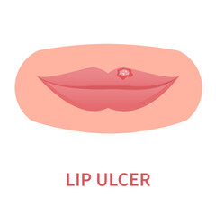 Lip ulcer oral disease icon. Lips inflammation, irritation, and ulceration with cracked and peeling skin. Painful sores, blisters, lesions. Dermatitis outbreak. Medical concept. Vector illustration. - obrazy, fototapety, plakaty