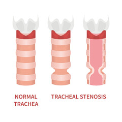 Tracheal stenosis awareness illustration. Trachea narrowing symbol. Difficulty breathing, hoarseness and voice change symptoms. Healthcare concept. Isolated flat vector illustration.