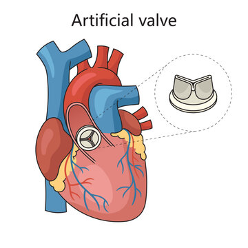 Artificial heart valve in human heart diagram schematic vector illustration. Medical science educational illustration