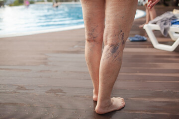 close-up of female old legs with varix - obrazy, fototapety, plakaty