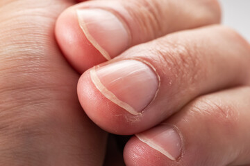 Ridged fingernails with vertical ridges.Nails problems