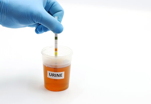 Doctor's or scientist's hand using a dipstick for a urinalysis