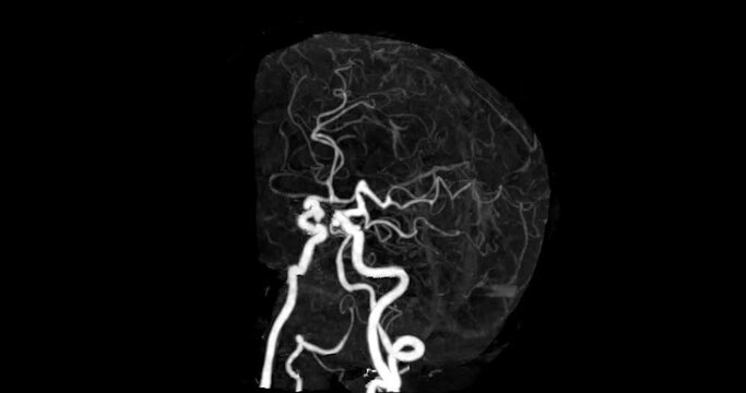 CTA Brain or computed tomography angiography of Cerebral  artery  MIP  image  turn around on the screen.
