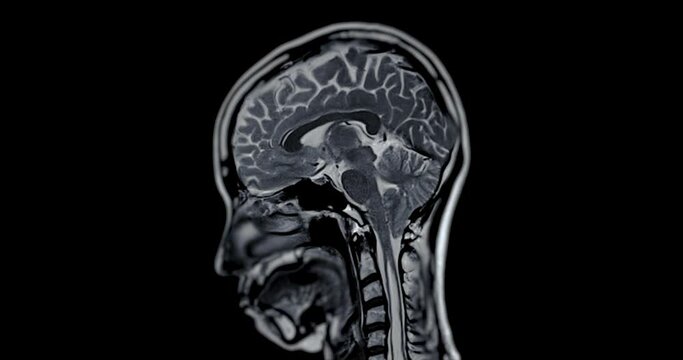 MRI brain sagittal T1W for detect Brain stroke disease.