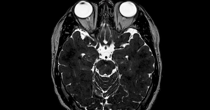 MRI Brain scan with  the internal auditory canal (IAC) axial view. 
