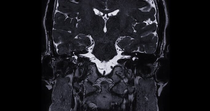 MRI Brain scan  with  the internal auditory canal (IAC) Coronal view. 