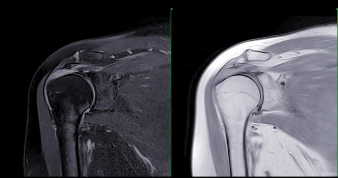 Magnetic Resonance Imaging or MRI of Shoulder Joint  Coronal T2FS and PDW  for diagnostic shoulder pain.
