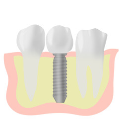 インプラントの歯と天然歯が並ぶイラスト